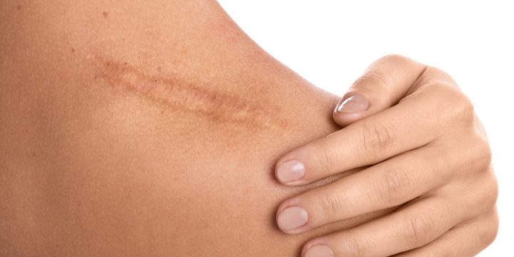 Aderenze cicatriziali: prevenzione e trattamento